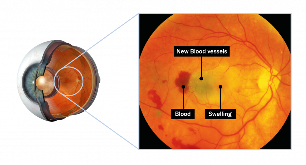 Macular Degeneration Symptoms, Causes, and Treatment College Review Journal